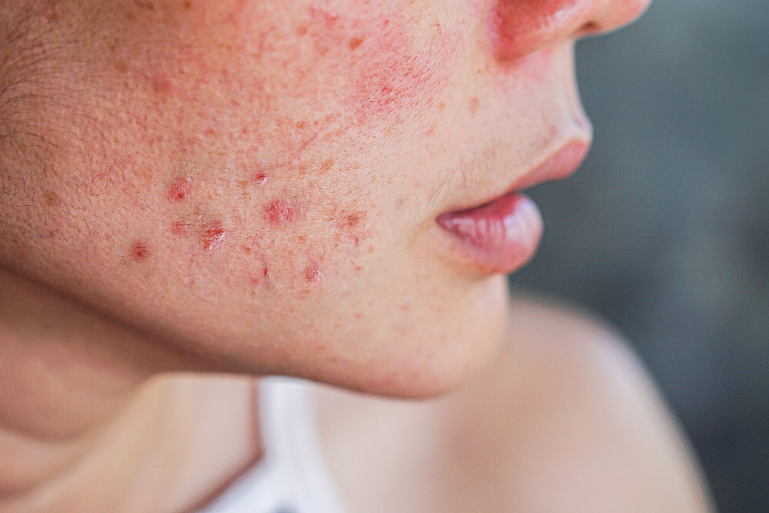 Acne patologia