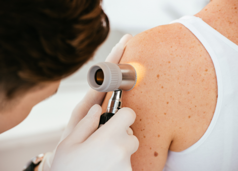 Prevenzione Melanoma: mai sottovalutare il problema!