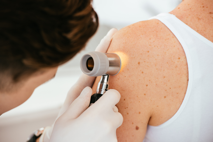 Prevenzione Melanoma: mai sottovalutare il problema!