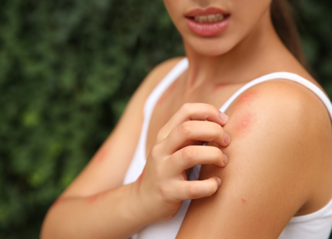 Punture di zanzare gonfiore eccessivo: come risolvere questo fastidioso problema