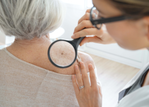 Controllo nei: perché e ogni quanto farlo