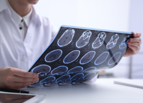 Cos’è la Sclerosi Multipla e come combatterla