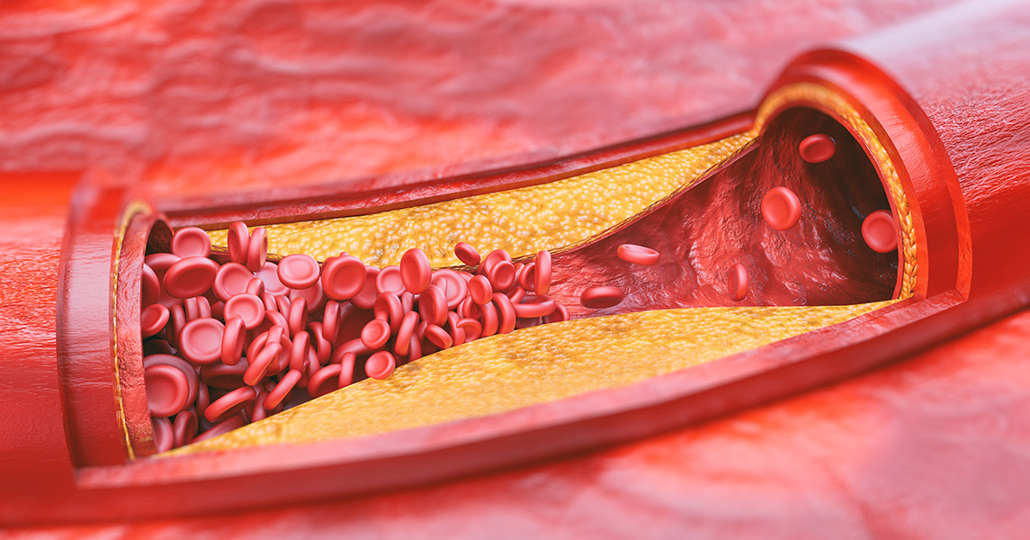 Aterosclerosi sintomi