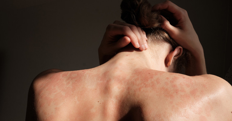 Dermatite da contatto