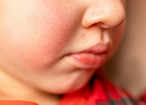 Come calmare il prurito da dermatite atopica?