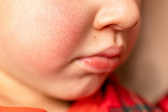 Come calmare il prurito da dermatite atopica?