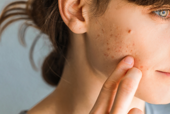 Curare l’acne ormonale senza pillola è possibile