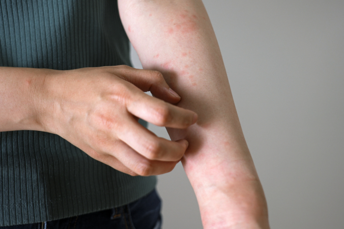 Quando un’allergia alimentare causa orticaria