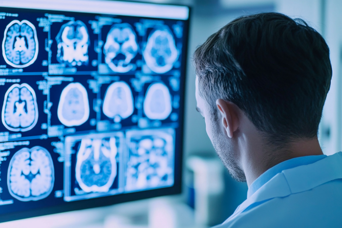 Qual è la differenza tra SLA e sclerosi multipla?
