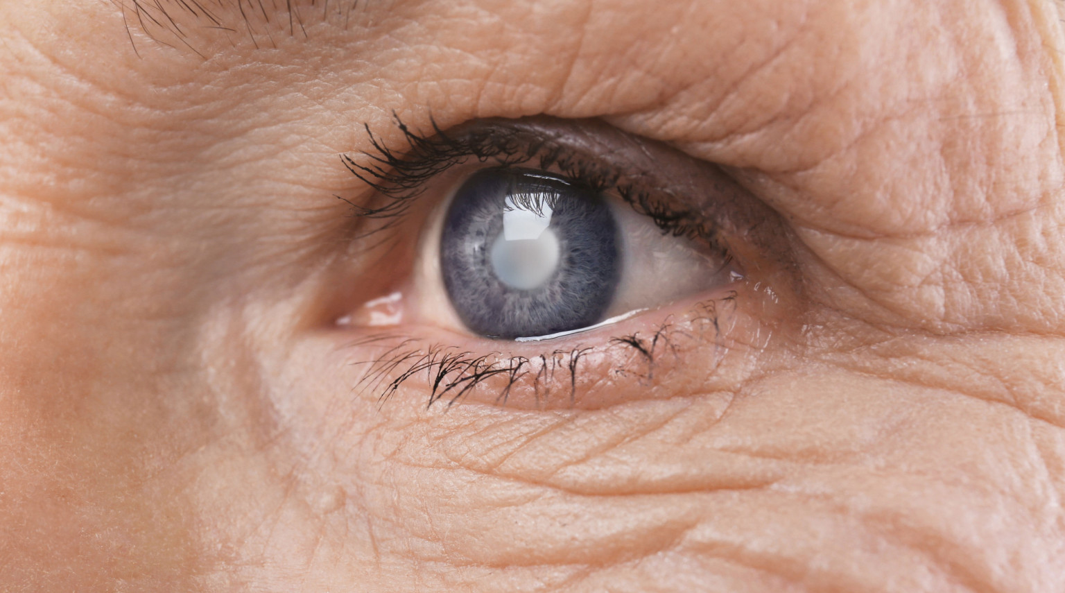 Intervento per la cataratta: quanto dura, come si svolge e tempi di recupero