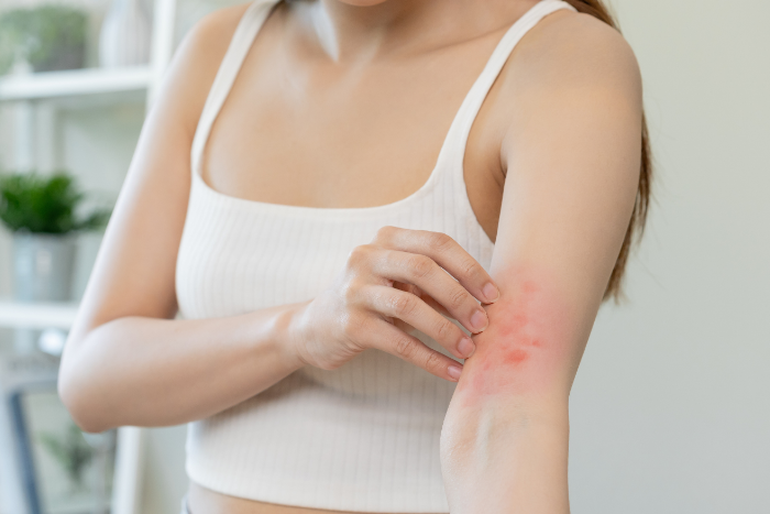 I rimedi per la dermatite da sudore