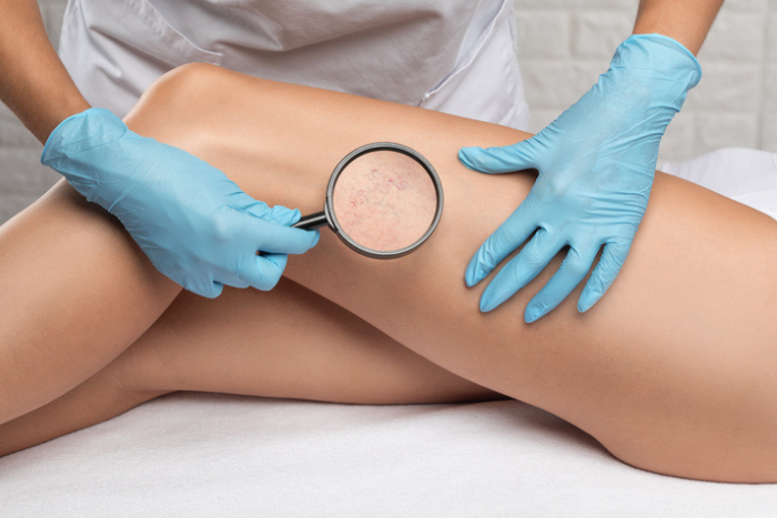Capillari delle gambe: come eliminarli?