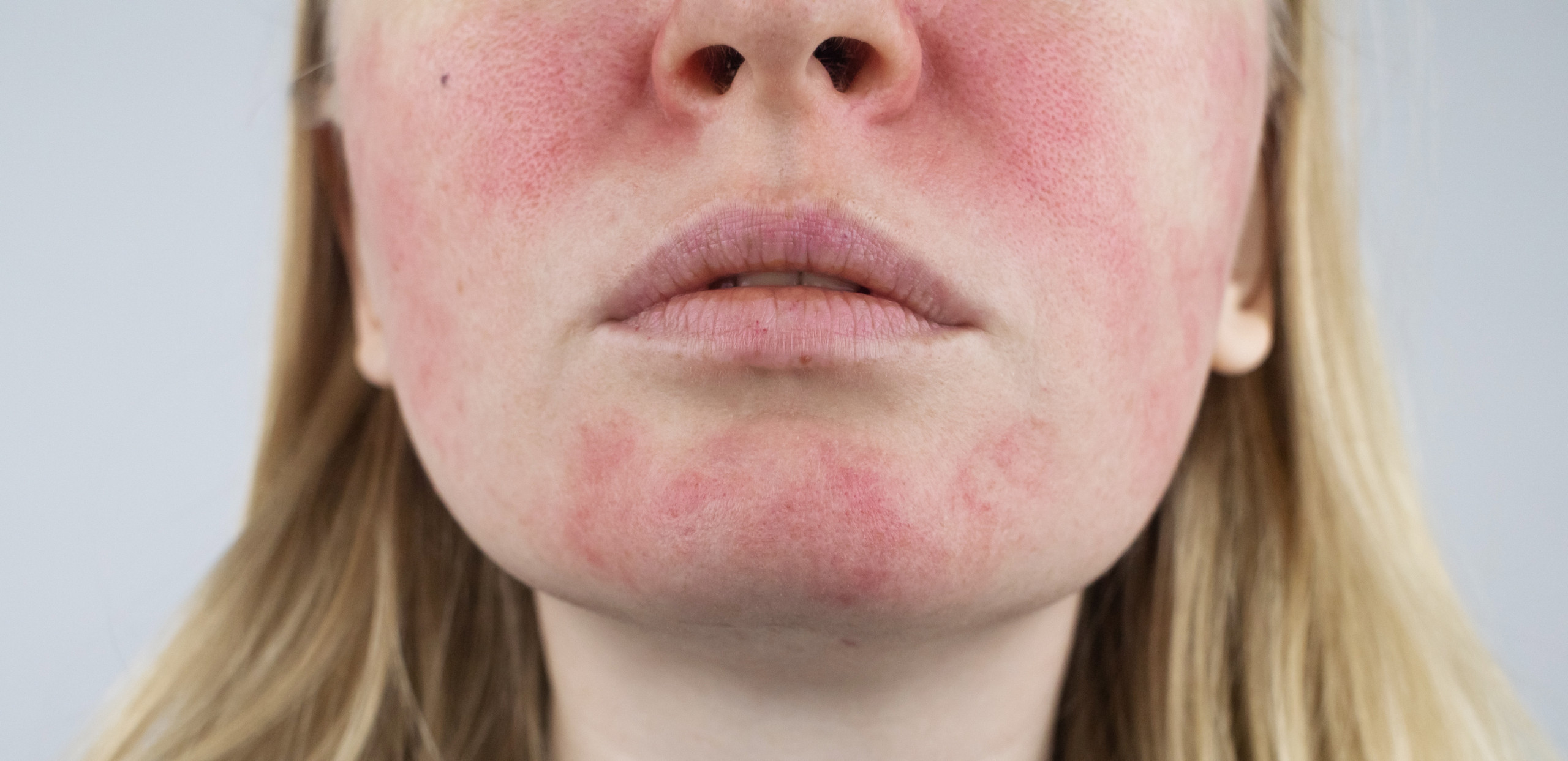 rosacea