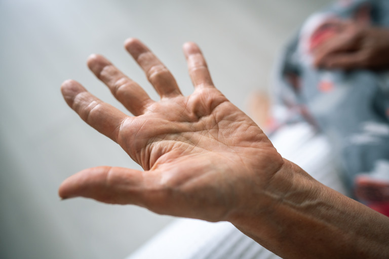 Malattia di Dupuytren