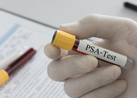 Esame del psa: tutto quello che c’è da sapere