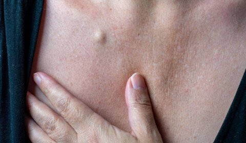 Asportazione di cisti sebacea