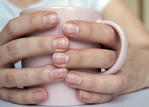 Si può riconoscere la carenza di ferro dai suoi sintomi?