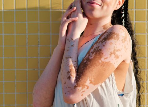 Vitiligine e sole: che cosa succede in estate?